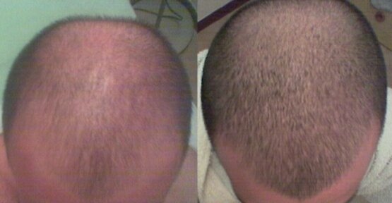 Minoxidil losyon ve şampuan