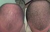 Minoxidil losyon ve şampuan