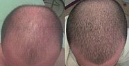 Minoxidil losyon ve şampuan